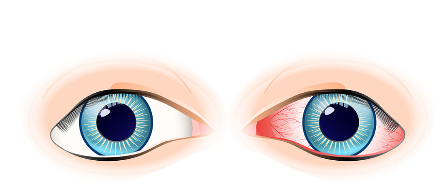 Diabetes and eyes – Symptoms of Diabetic retinopathy